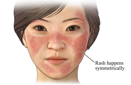 Lupus rash on womans face